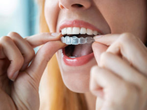 girl putting in invisalign