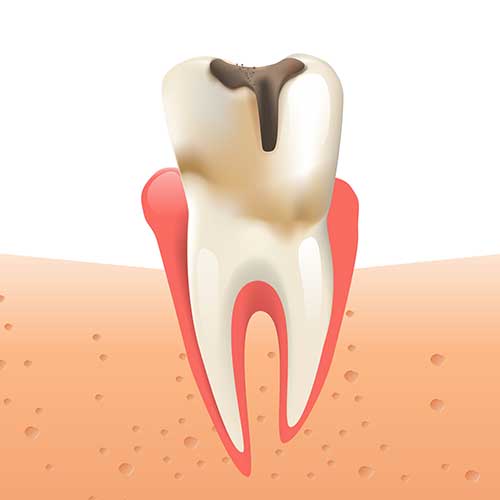 cavity graphic